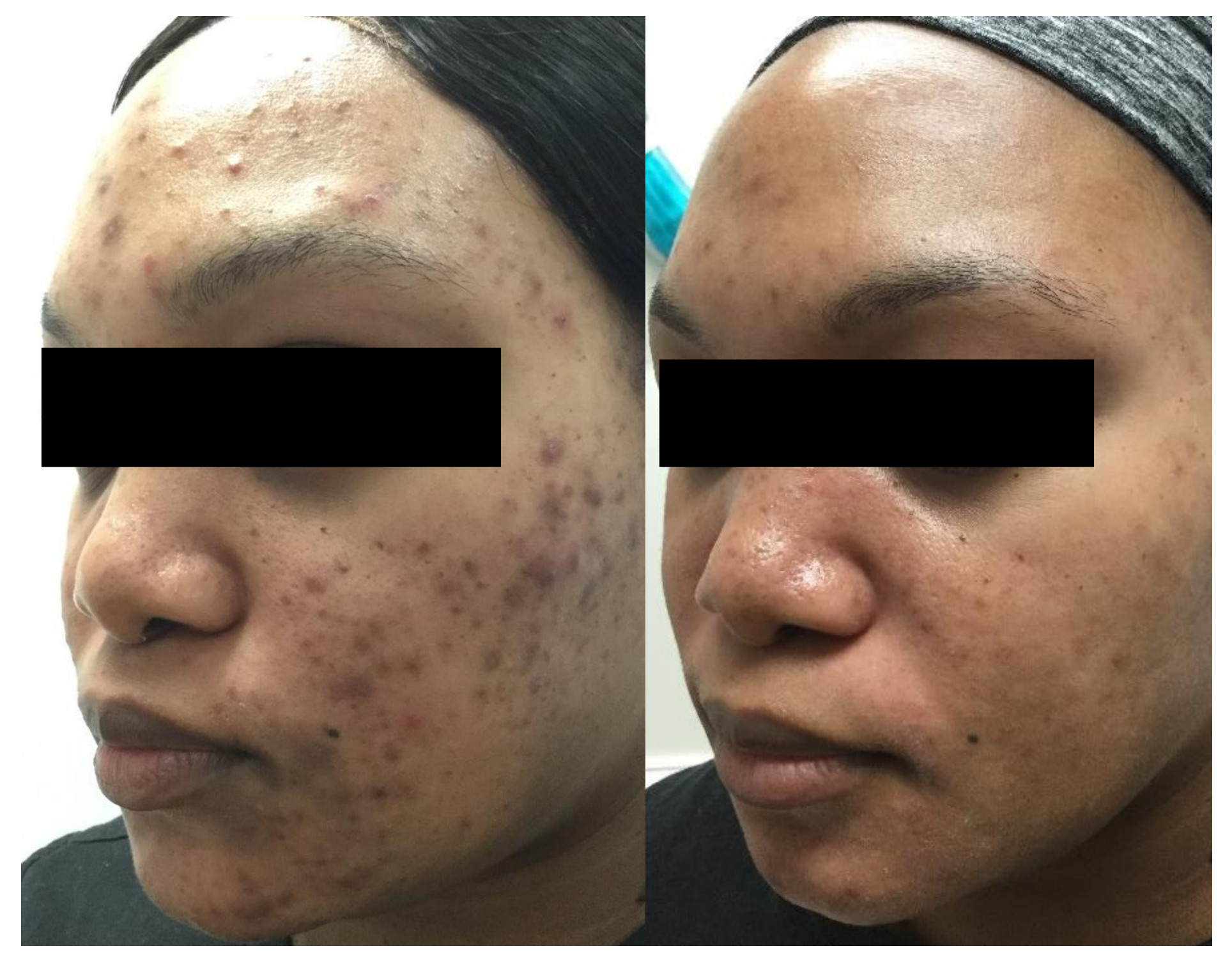 3 months of treatmen