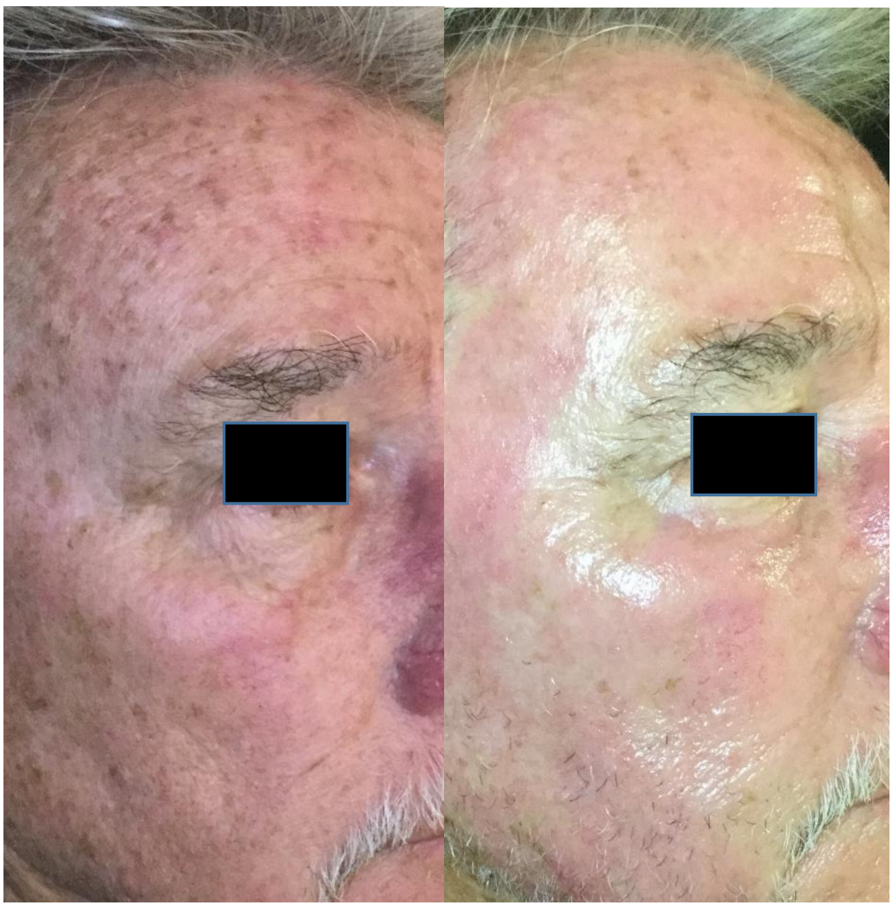 1 week after a medium depth peel