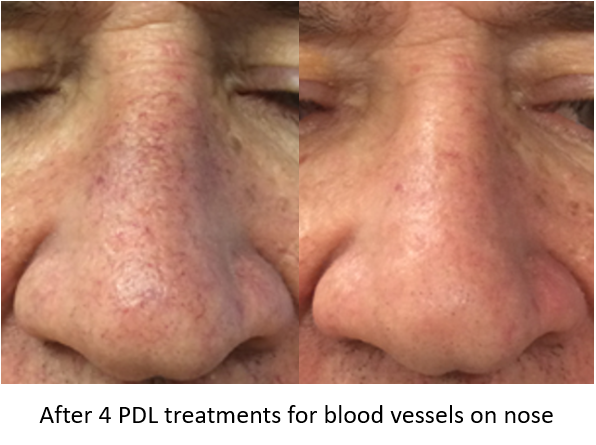 Laser Treatments Before and After