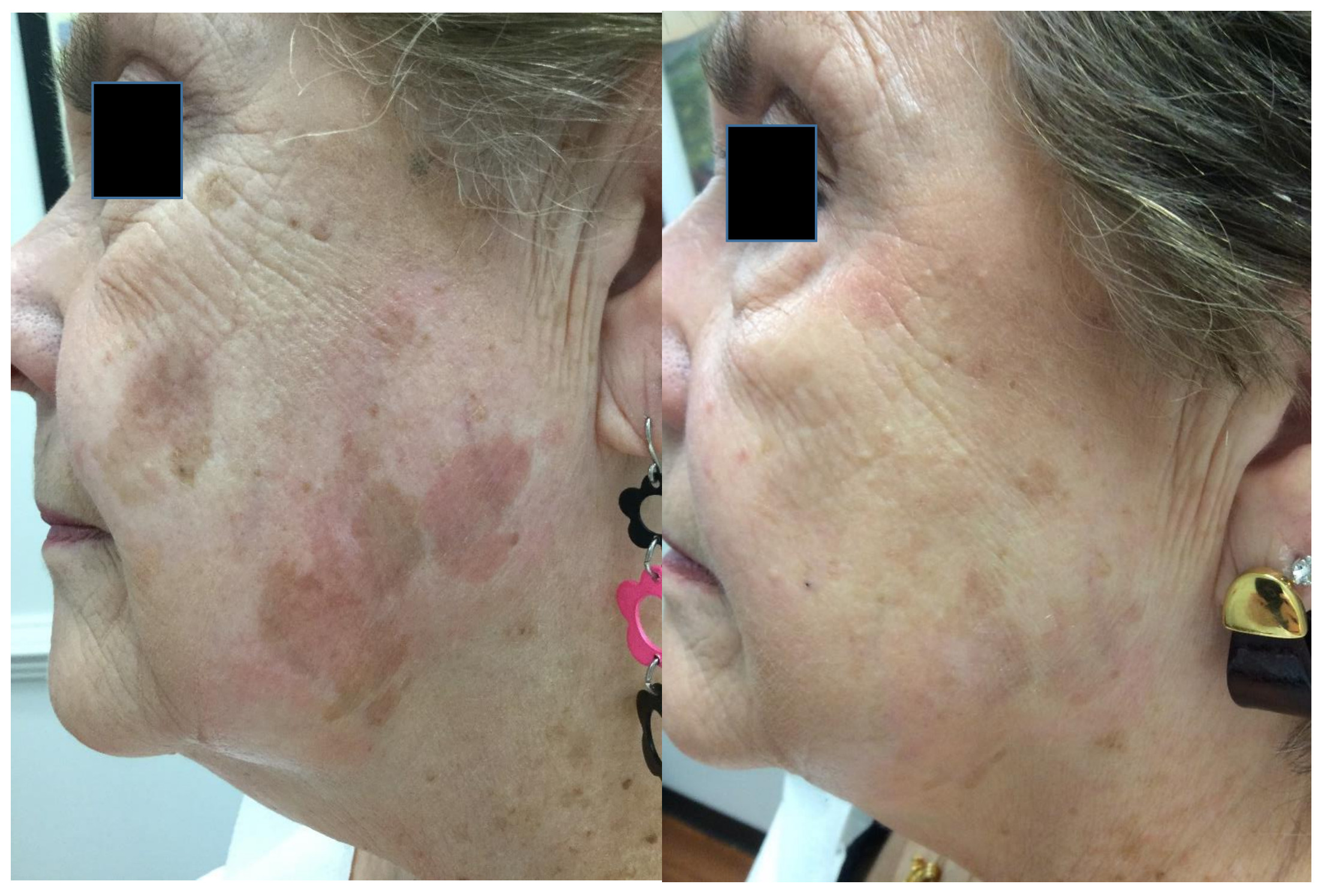 4 months after treatment of sunspots with cryotherapy